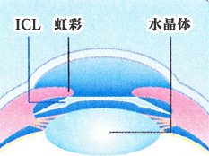 ICL装着図